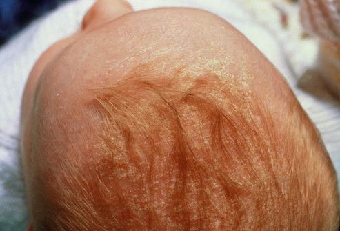 Причины шелушения кожи головы у грудничков