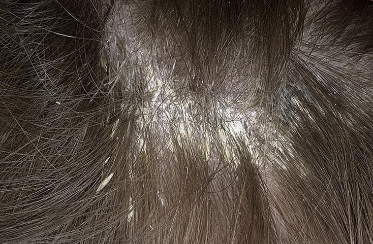 Причины шелушения кожи головы