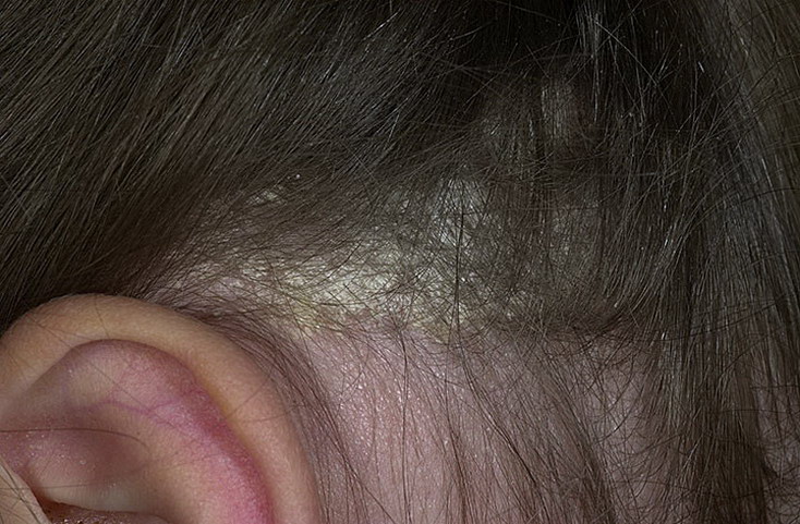 шелушения кожи головы фото 1