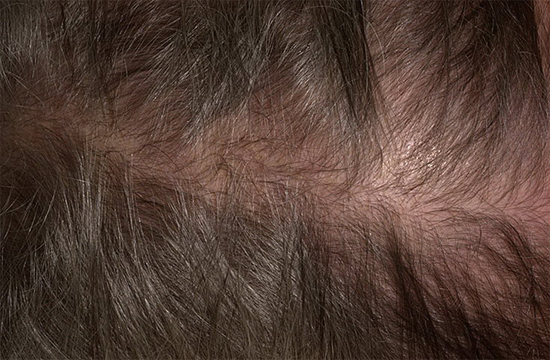 Диффузное-выпадение-волос