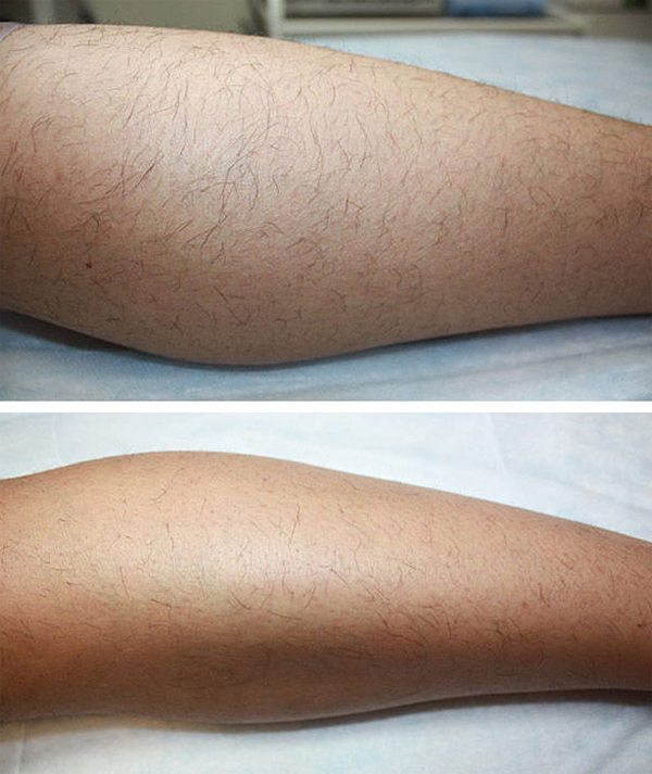 Риванол отзывы удаление волос на ногах фото до и после