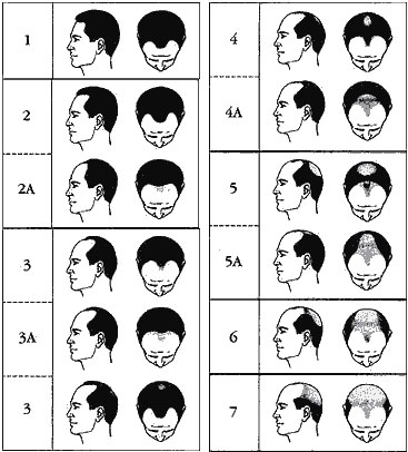 выпадения волос у мужчин Стадии шкалы Гамильтона-Норвуд