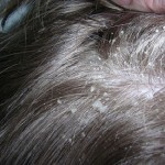заболевания волос и кожи головы перхоть себорея