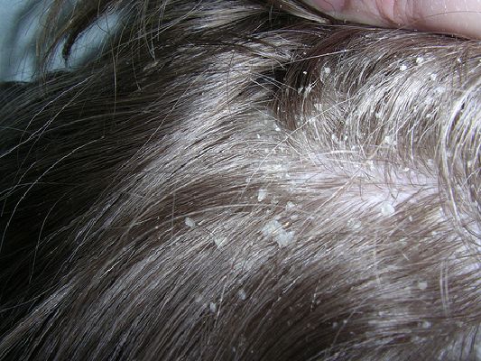 заболевания волос и кожи головы перхоть себорея