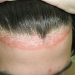 псориаз волосистой части головы симптомы