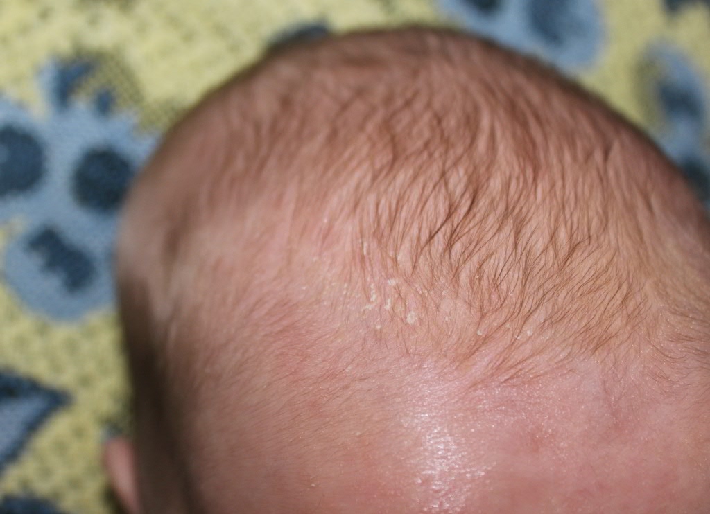 Почему у ребенок может родиться с белым пятном на волосах